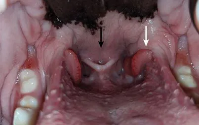 long soft palate and hyperplastic tonsils
