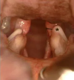normal soft palate and larynx