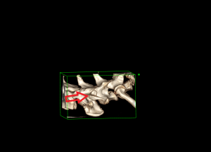 Mo Hewitt X-ray